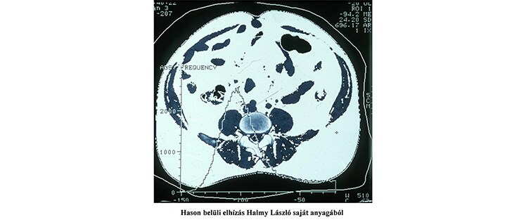 Az elhízottak érelmeszesedésének megelőzése Az elhízottak érelmeszesedésének megelőzése